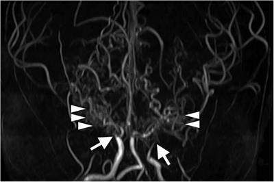 Case Report: RNF213 variant and choroidal anastomosis as potential risk factors for early stroke in moyamoya syndrome associated with Down syndrome